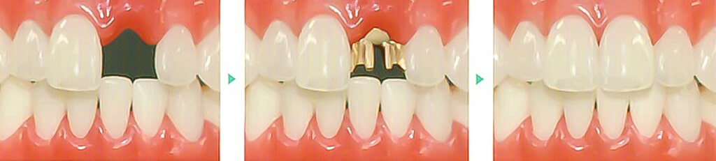 前歯１本のヒューマンブリッジ治療例１