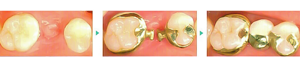 奥歯１本のヒューマンブリッジ治療例